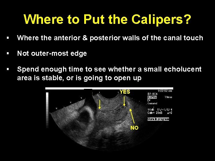 Where to Put the Calipers? § Where the anterior & posterior walls of the