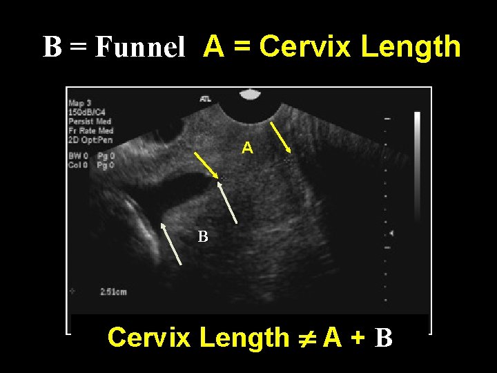 B = Funnel A = Cervix Length A B Cervix Length A + B