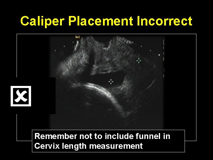 Caliper Placement Incorrect Remember not to include funnel in Cervix length measurement 