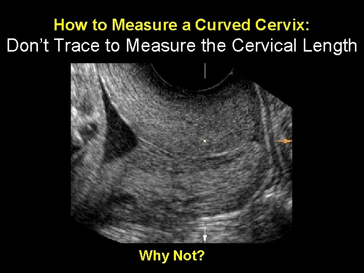 How to Measure a Curved Cervix: Don’t Trace to Measure the Cervical Length Why