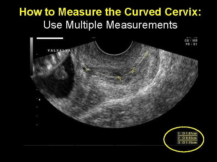 How to Measure the Curved Cervix: Use Multiple Measurements 