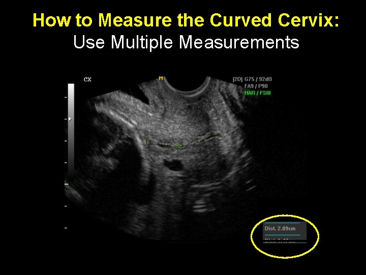 How to Measure the Curved Cervix: Use Multiple Measurements 