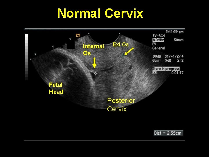 Normal Cervix Bladder Empty Internal Os Ext Os Fetal Head Posterior Cervix 