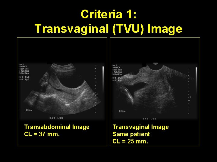 Criteria 1: Transvaginal (TVU) Image Transabdominal Image CL = 37 mm. Transvaginal Image Same