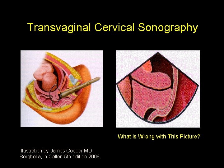 Transvaginal Cervical Sonography What is Wrong with This Picture? Illustration by James Cooper MD