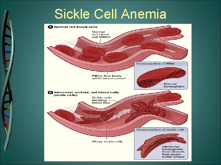 Sickle Cell Anemia 