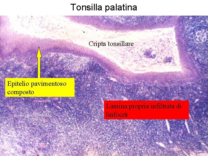 Tonsilla palatina Cripta tonsillare Epitelio pavimentoso composto Lamina propria infiltrata di linfociti 