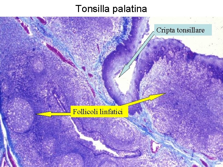 Tonsilla palatina Cripta tonsillare Follicoli linfatici 