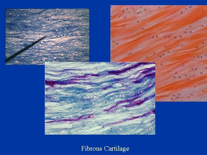 Fibrous Cartilage 