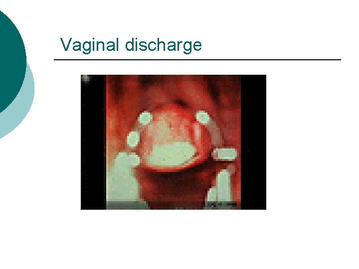 Vaginal discharge 