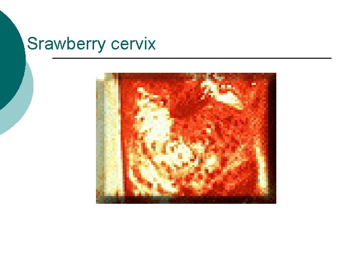 Srawberry cervix 