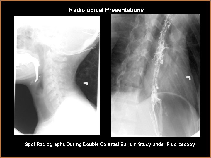 Radiological Presentations Spot Radiographs During Double Contrast Barium Study under Fluoroscopy 