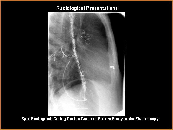 Radiological Presentations Spot Radiograph During Double Contrast Barium Study under Fluoroscopy 