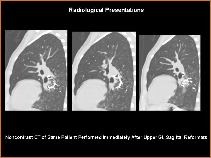 Radiological Presentations Noncontrast CT of Same Patient Performed Immediately After Upper GI, Sagittal Reformats