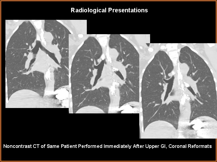 Radiological Presentations Noncontrast CT of Same Patient Performed Immediately After Upper GI, Coronal Reformats