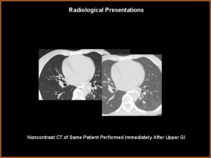 Radiological Presentations Noncontrast CT of Same Patient Performed Immediately After Upper GI 