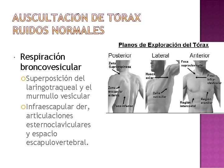  Respiración broncovesicular Superposición del laringotraqueal y el murmullo vesicular Infraescapular der, articulaciones esternoclaviculares