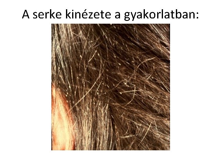 A serke kinézete a gyakorlatban: 