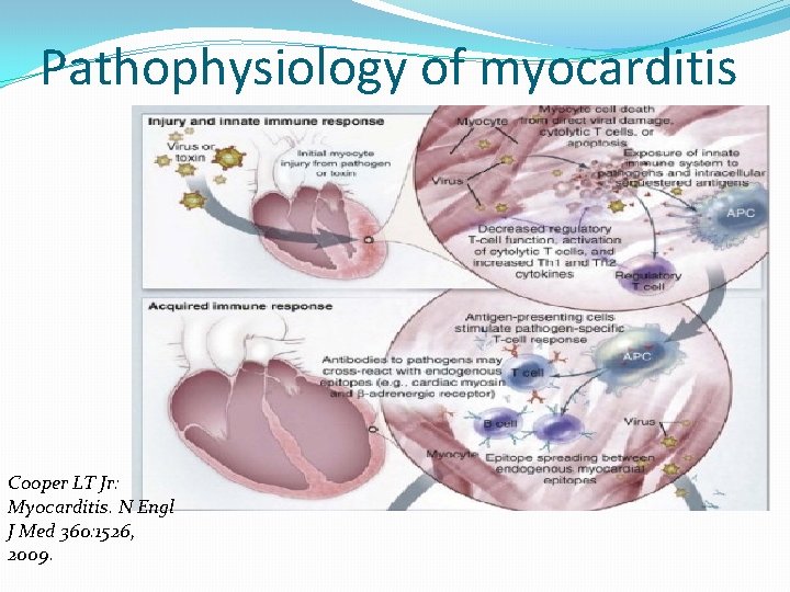 Pathophysiology of myocarditis Cooper LT Jr: Myocarditis. N Engl J Med 360: 1526, 2009.