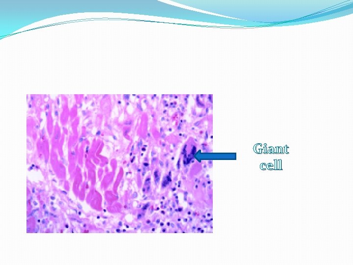 Giant cell 