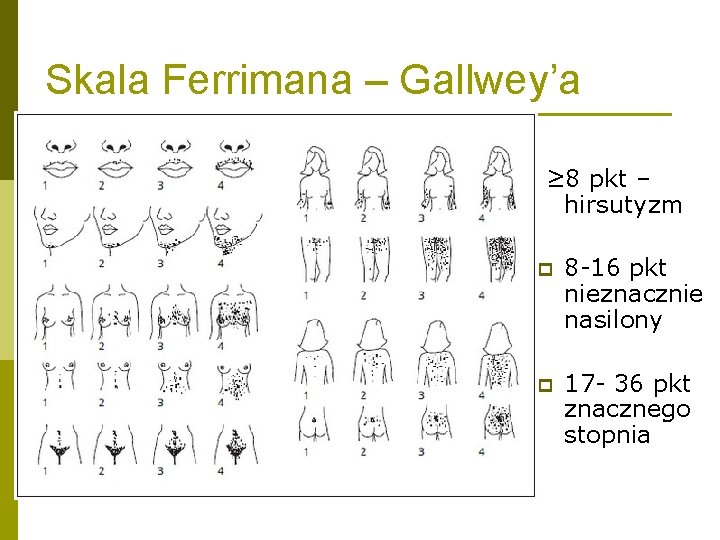 Skala Ferrimana – Gallwey’a ≥ 8 pkt – hirsutyzm p 8 -16 pkt nieznacznie