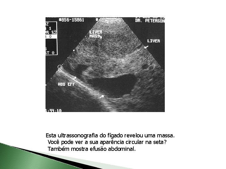 Esta ultrassonografia do fígado revelou uma massa. Você pode ver a sua aparência circular