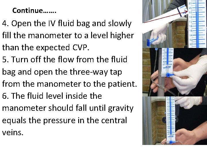 Continue……. 4. Open the IV fluid bag and slowly fill the manometer to a Continue……. 4. Open the IV fluid bag and slowly fill the manometer to a