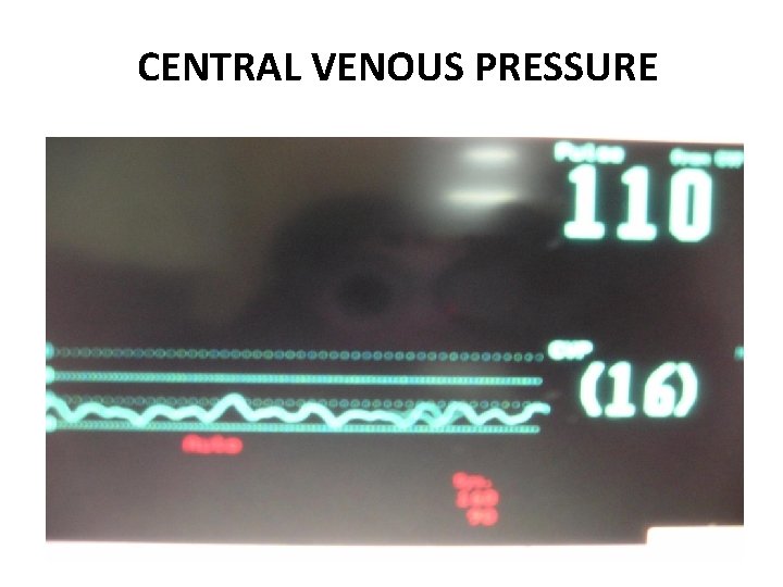 CENTRAL VENOUS PRESSURE 