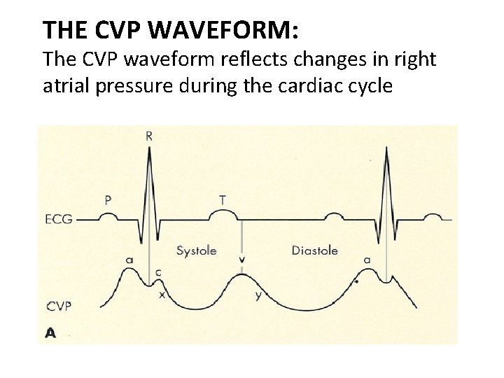 THE CVP WAVEFORM: The CVP waveform reflects changes in right atrial pressure during the