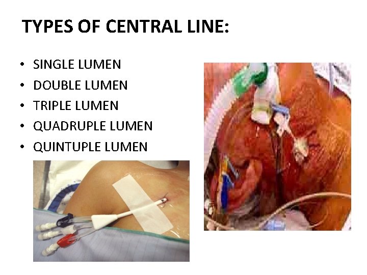 TYPES OF CENTRAL LINE: • • • SINGLE LUMEN DOUBLE LUMEN TRIPLE LUMEN QUADRUPLE