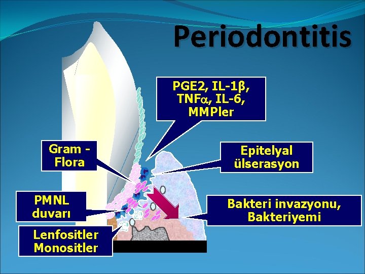 Periodontitis PGE 2, IL-1β, TNF , IL-6, MMPler Gram Flora PMNL duvarı Lenfositler Monositler