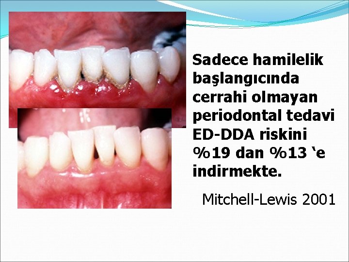 Sadece hamilelik başlangıcında cerrahi olmayan periodontal tedavi ED-DDA riskini %19 dan %13 ‘e indirmekte.
