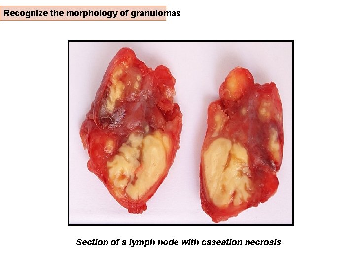 Recognize the morphology of granulomas Section of a lymph node with caseation necrosis 