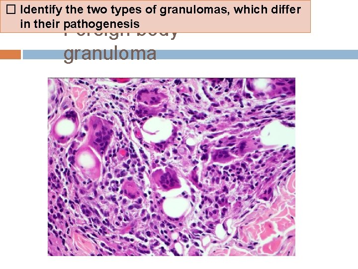 � Identify the two types of granulomas, which differ in their pathogenesis Foreign body