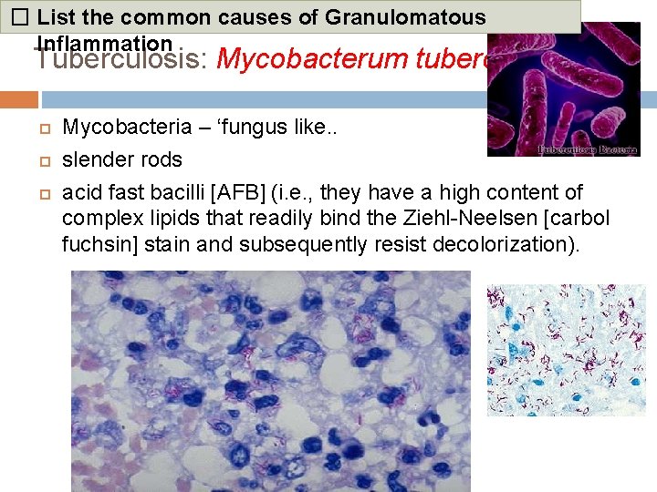 � List the common causes of Granulomatous Inflammation Tuberculosis: Mycobacterum tuberculosis Mycobacteria – ‘fungus