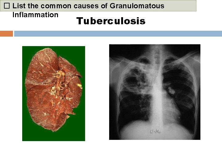 � List the common causes of Granulomatous Inflammation Tuberculosis 