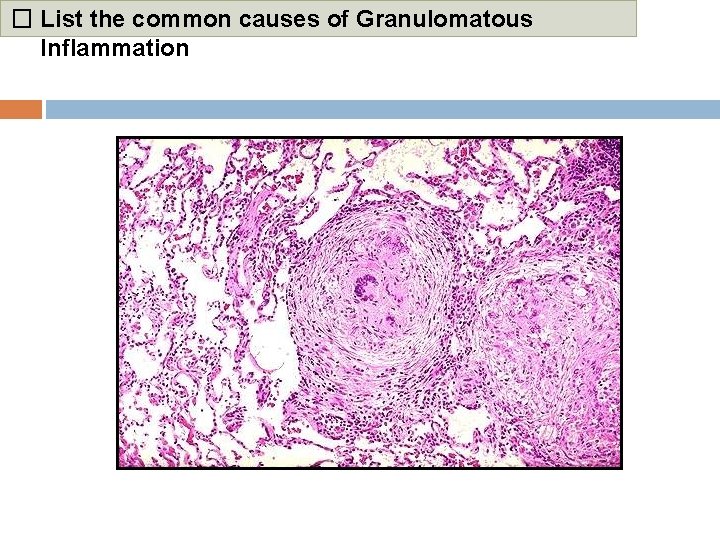 � List the common causes of Granulomatous Inflammation 