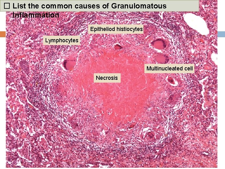 � List the common causes of Granulomatous Inflammation Epitheliod histiocytes Lymphocytes Multinucleated cell Necrosis