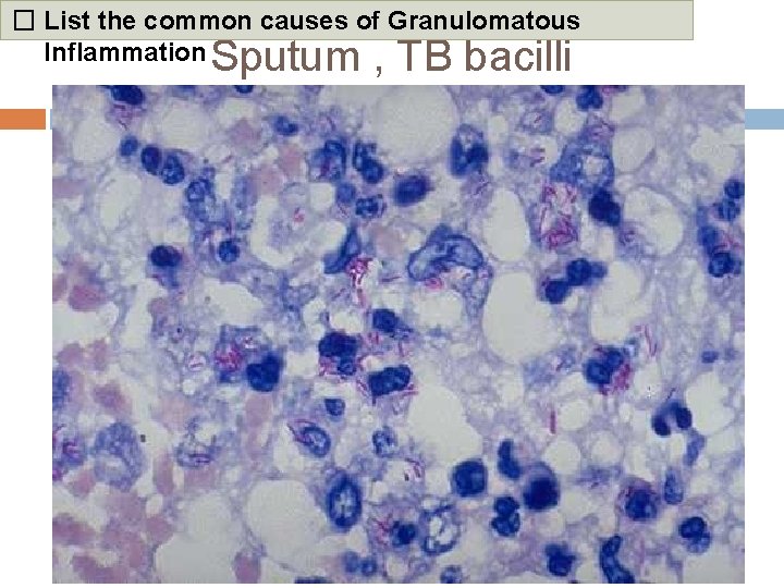 � List the common causes of Granulomatous Inflammation Sputum , TB bacilli 