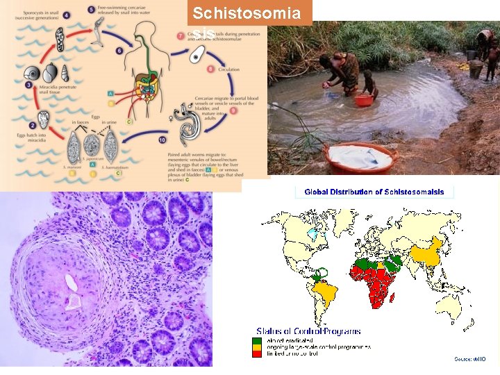 Schistosomia sis 