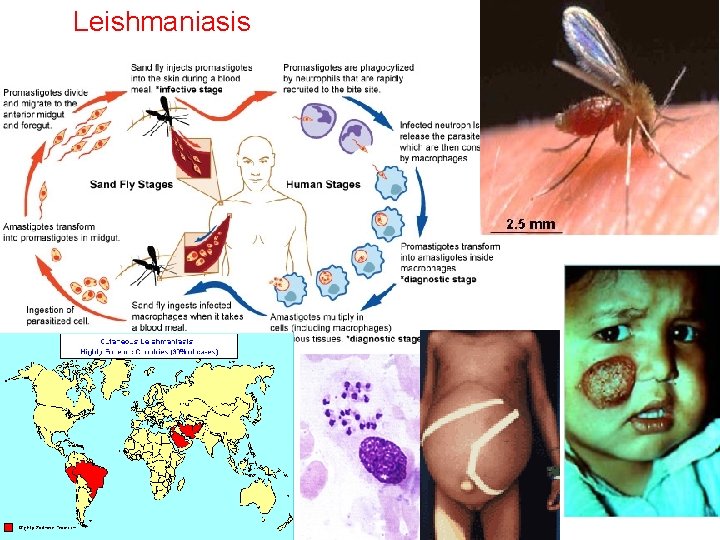 Leishmaniasis 