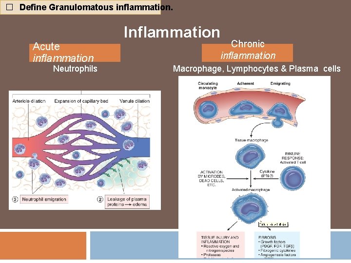 � Define Granulomatous inflammation. Inflammation Acute inflammation Neutrophils Chronic inflammation Macrophage, Lymphocytes & Plasma
