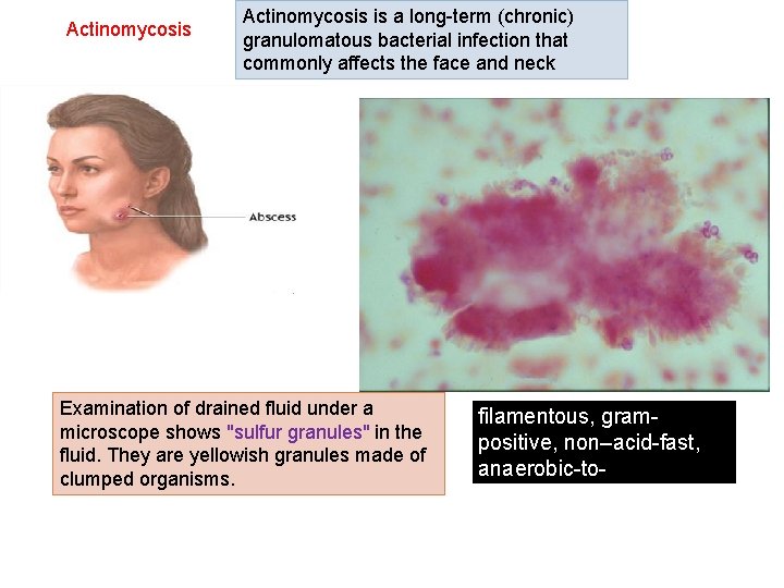 Actinomycosis is a long-term (chronic) granulomatous bacterial infection that commonly affects the face and