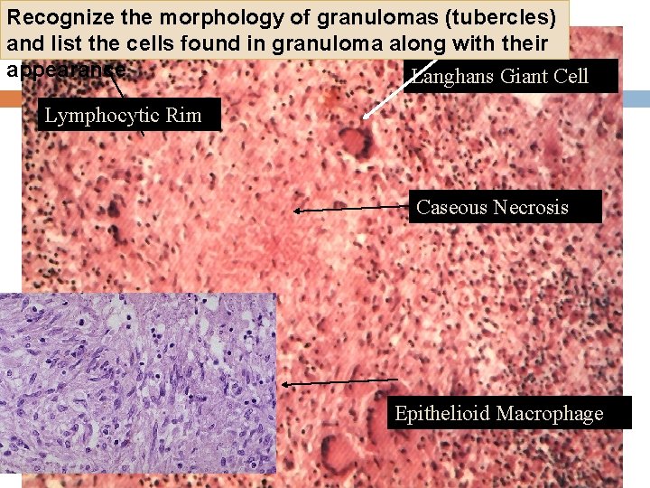 Recognize the morphology of granulomas (tubercles) and list the cells found in granuloma along