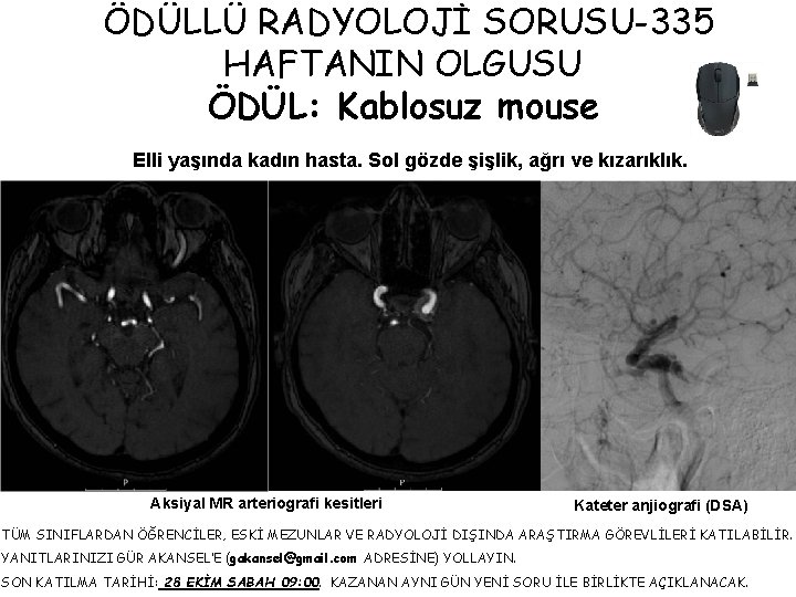 ÖDÜLLÜ RADYOLOJİ SORUSU-335 HAFTANIN OLGUSU ÖDÜL: Kablosuz mouse Elli yaşında kadın hasta. Sol gözde