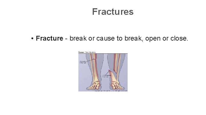 Fractures • Fracture - break or cause to break, open or close. 