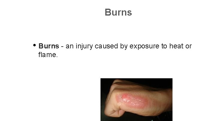 Burns • Burns - an injury caused by exposure to heat or flame. 