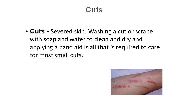 Cuts • Cuts - Severed skin. Washing a cut or scrape with soap and