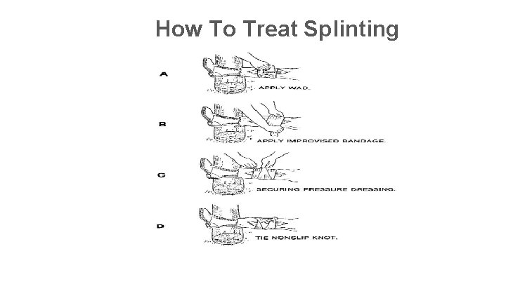 How To Treat Splinting 
