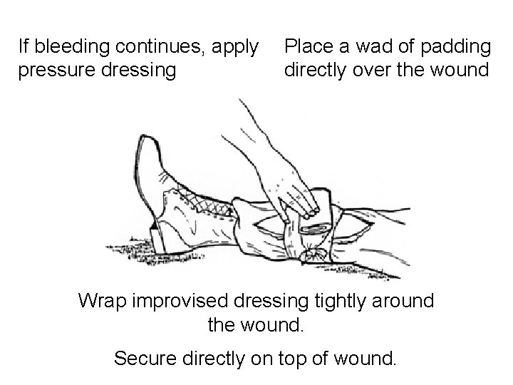 If bleeding continues, apply pressure dressing Place a wad of padding directly over the